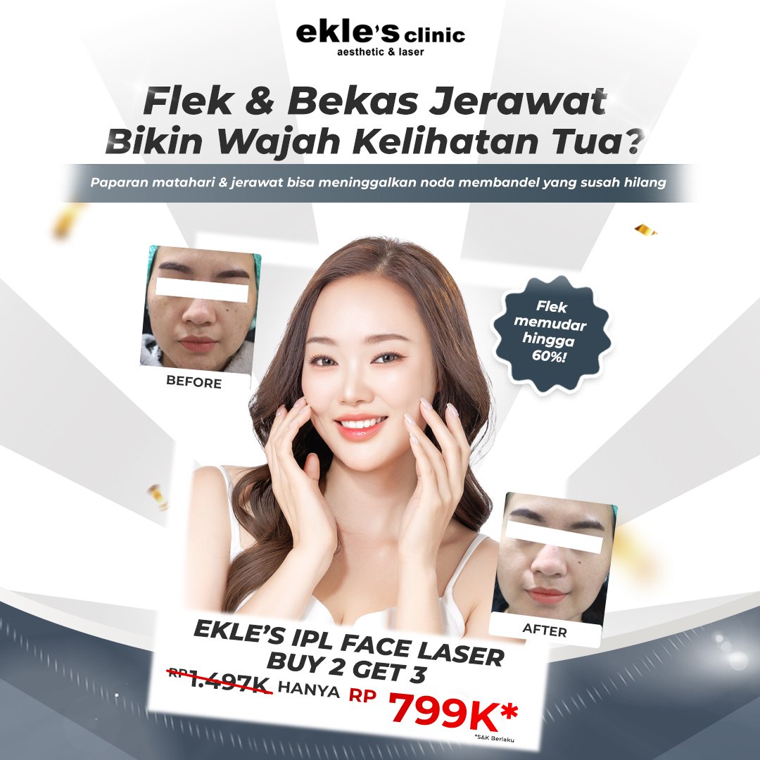 IPL LASER FACE-PIGMEN/ACNE (B2G3)